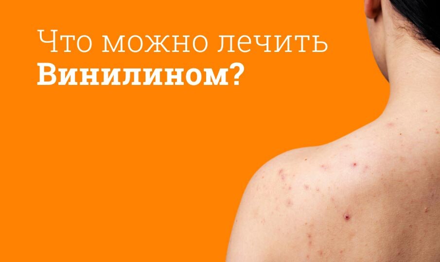 Что можно лечить Винилином?