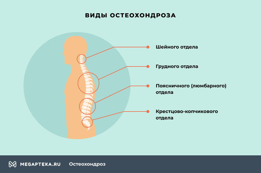 Матрас при остеохондрозе шейного отдела