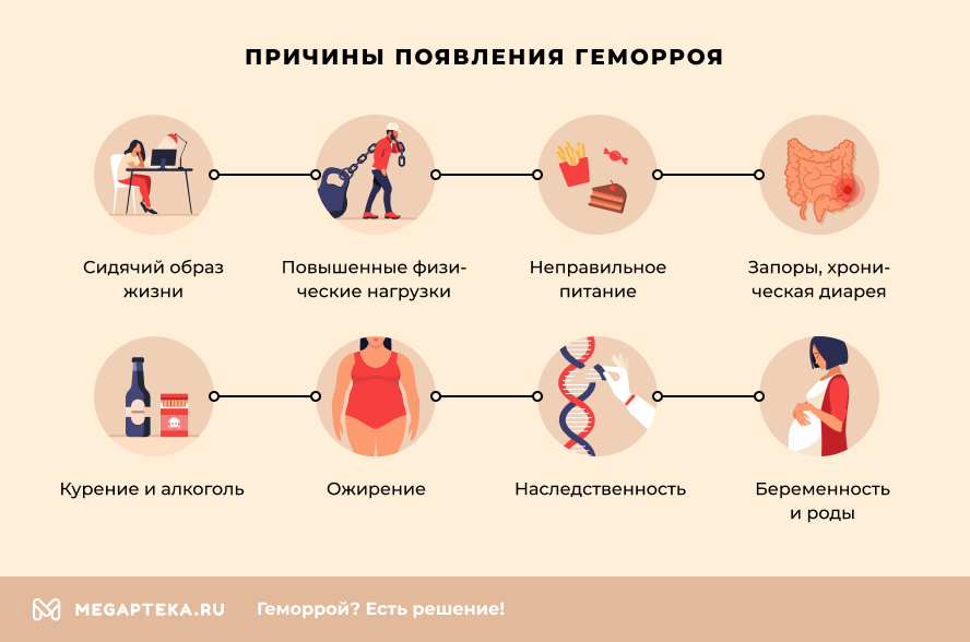 Геморрой причины возникновения